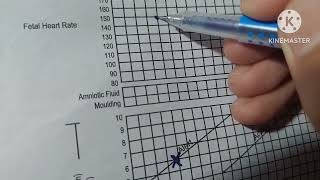 Partograph Plotting in Bangla with Mnemonics [upl. by Teyugn]