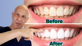 Whiten Your Teeth at Home the DIY Way  Dr Mandell [upl. by Caiaphas452]