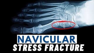 Navicular Stress Fractures  Symptoms Causes Diagnosis amp Treatment [upl. by Aehsila]