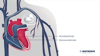 Herzschrittmacher Aufbau amp Funktion Animation Medizin [upl. by Schilt516]