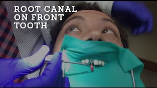 Root Canal Treatment Demonstration A how to procedure on Front Tooth in HD [upl. by Tamra]