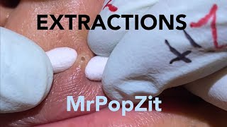 Acne ExtractionsBlackheads for days 5 Nothing but the popCreamy pore pops Blackheadswhiteheads [upl. by Sisile]