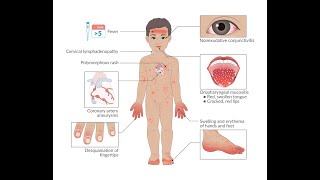 Kawasaki Disease Vasculitis Rheumatology [upl. by Os]