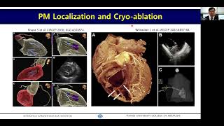 221120 Papillary Muscle VT ABL 박희남 교수 Hui Nam Pak [upl. by Mackintosh963]