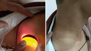 cystic hygroma neck  transillumination test [upl. by Ymirej]