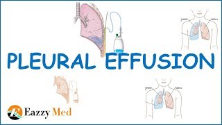 Pleural Effusion Causes ClassificationSymptoms and Treatment [upl. by Myra]