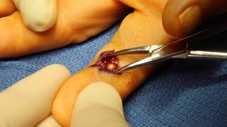 Live Surgery Foreign Body BB Removal from Finger [upl. by Essirahc]