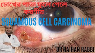 Squamous Cell Carcinoma in Eye  Symptoms amp Treatment চোখের পাতা ফুলে গেলে করণীয়  DR RAIHAN RABBI [upl. by Krall]