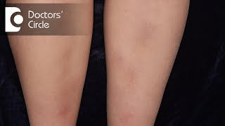 How to manage Lichen Planus present in the legs  Dr Rajdeep Mysore [upl. by Malonis]