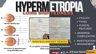 Hypermetropia Of Eye  Hypermetropia  Long Sightedness  Ophthalmology With Notes [upl. by Kcirdot315]