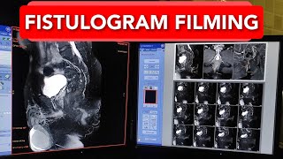 Fistulogram MRI scan Filming Technique [upl. by Eannyl414]