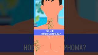 What is HODGKINS LYMPHOMA [upl. by Lewellen]