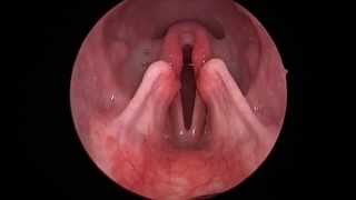 Dog Lar Par Laryngeal paralysis observed in sedated canine oral exam [upl. by Edwards104]