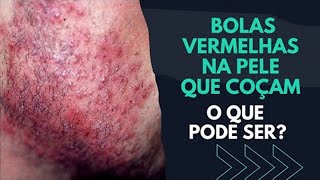 BOLINHAS VERMELHAS NA PELE O QUE PODE SER [upl. by Faires]