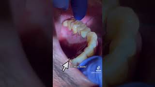 Dental Bone lost  Periodontal problem and teeth mobility [upl. by Hgeilhsa]