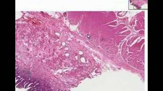 Histopathology Esophagus Barrett esophagus [upl. by Corsiglia]