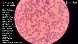 Leukemoid Reaction [upl. by Sigler92]