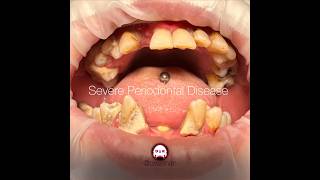 Severe Periodontal Disease with bone loss generalized inflammation and tissue edema [upl. by Elisabet]