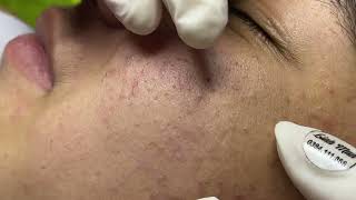 Acne treatment for Spa Linh Mun 2023 026 [upl. by Isiah]