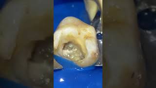 access opening of maxillary first molar [upl. by Ravaj]