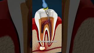 how is an endodontics dentista Endodontics salud love [upl. by Filomena]