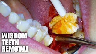 Full Wisdom Teeth Removal Procedure Emergency Extraction of Impacted amp Partially Erupted Molar [upl. by Ahsin]