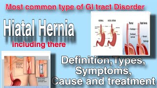 Define Hiatal Hernia  Define Achalasia  Including there Types  Symptoms  Causes  management [upl. by Aniteb285]