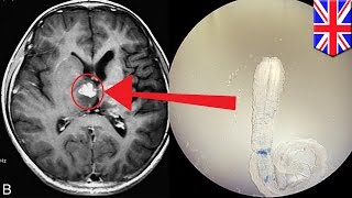 Tapeworm infection Rare brain worm took 4 years to crawl across UK man’s brain [upl. by Ayotas]