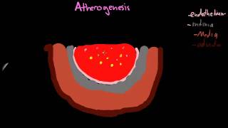 Atherogenesis part 1mp4 [upl. by Lancelot]