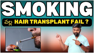 AskDrJohnWatts  SMOKING వల్ల HAIR TRANSPLANT FAIL   Hair Specialist Explains [upl. by Arron193]