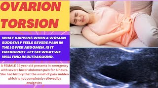 Ovarian torsion ultrasound  ovarian torsion ultrasound  pelvic pain lower abdominal pain in women [upl. by Tennek]