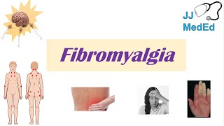 Fibromyalgia  Symptoms Associated Conditions Diagnosis Treatment [upl. by Erdnassak]