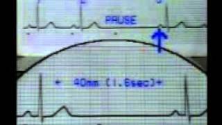 Learning ECG  Sinus Pause and Escape Beats 1 [upl. by Airamat]