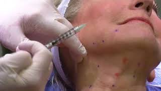 Injection of Botulinum Toxin to Platysma Bands [upl. by Plato756]