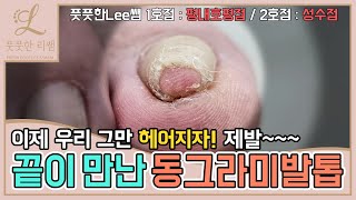 ENG SUB끝이 만난 동그라미발톱 이제 그만 헤어지자 ingrown toenail  ingrowing nail  Fresh Foot 풋풋한리쌤 성수점  평내호평점 [upl. by Llen]