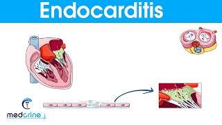 Endocarditis  causes symptoms pathophysiology diagnosis and treatment [upl. by Haroppiz]