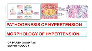 Hypertension  Pathogenesis  Morphology  Arteriosclerosis [upl. by Ettenotna]