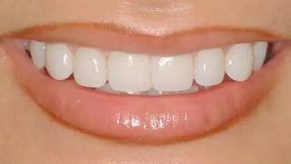 Claudia A Lumineers Veneers Case Study  30Second Dentistry™ [upl. by Ul500]