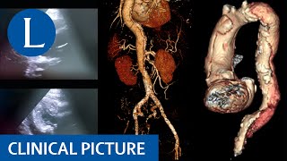 Leg weakness and paraesthesia provides a clue to sudden death [upl. by Slaohcin]