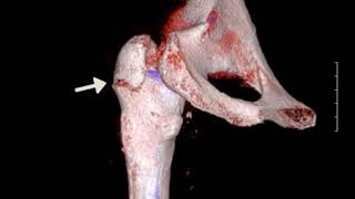 Comminuted Fracture Of The Left Greater Trochanter [upl. by Dhaf]