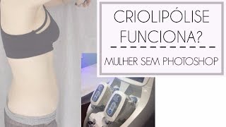 Criolipolise funciona Meu tratamento e resultado [upl. by Emixam188]