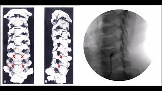 How to perform Stellate Ganglion Block Treatment [upl. by Lemuel]