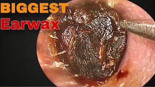 BIGGEST Earwax Difficult Removal EP 10  Doctor Anh [upl. by Euphemie]