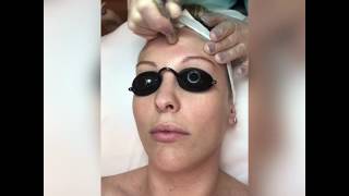 Microdermabrasion Treatment for Facial Rejuvenation [upl. by Arihppas263]