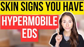 Unlocking The Secrets 12 Surprising Skin Signs Of Hypermobile EhlersDanlos Syndrome [upl. by Ybhsa]