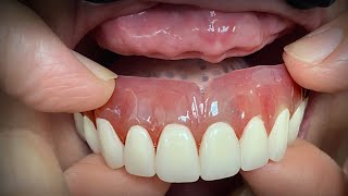 Finalizing a Highly Esthetic Denture with Dentist amp Patient InLab [upl. by Eisoj]