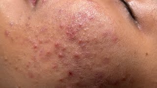 Blackheads amp Whiteheads Removal New 2024  Acne Treatment With Bo Nguyễn Spa 003 [upl. by Agustin]