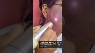 Birthmark removal Nevus of Ota By Q switch NdYAG laser ✅ [upl. by Soll]