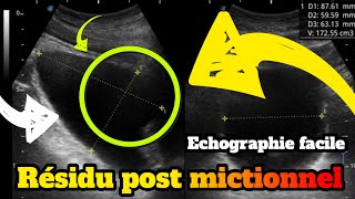 Evaluation du résidu post mictionnel en échographie [upl. by Nireil]