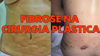 FIBROSE NA CIRURGIA PLÁSTICA [upl. by Nauqram680]